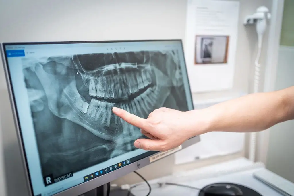 Wisdom  Teeth Extractions