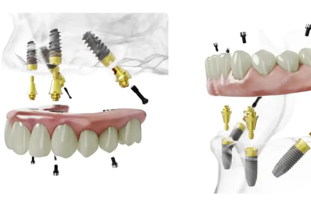 All on 4 — teeth on implants